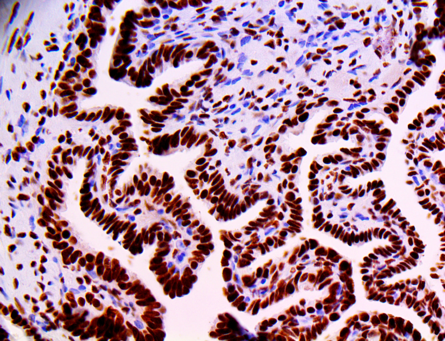 Progesterone Receptor
