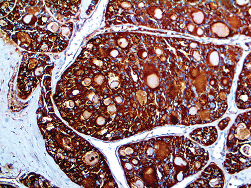 Thyroglobulin