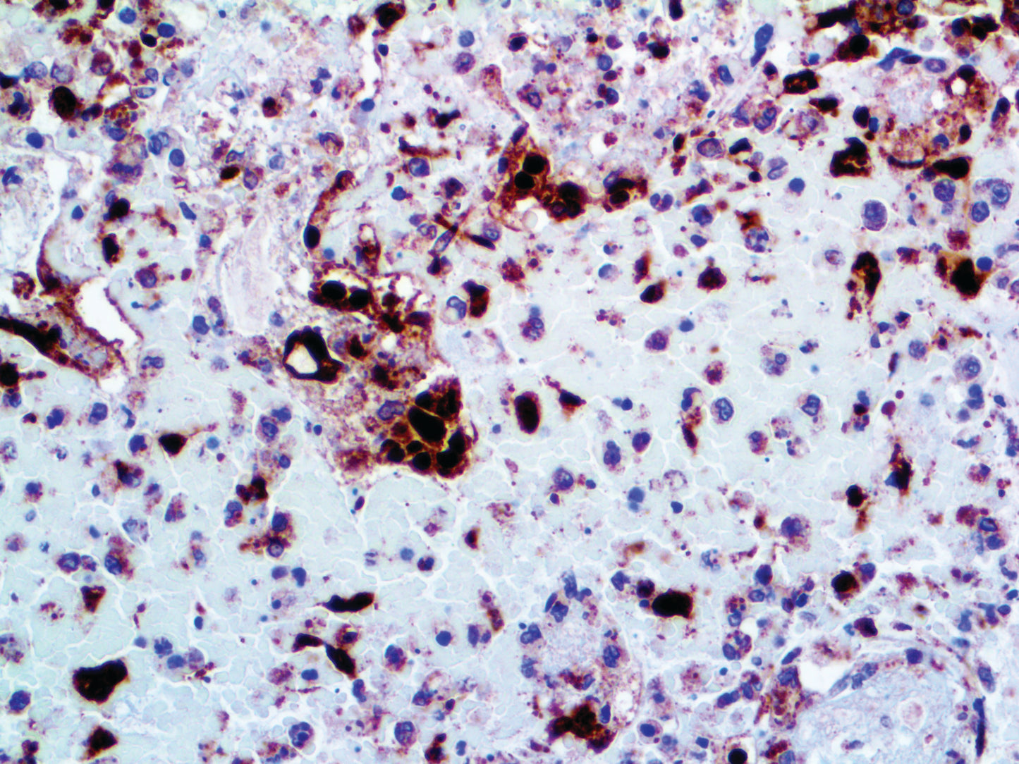Herpes Simplex Virus II