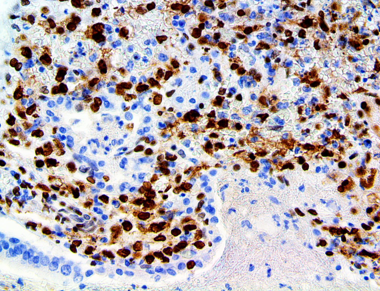 Herpes Simplex Virus I & II