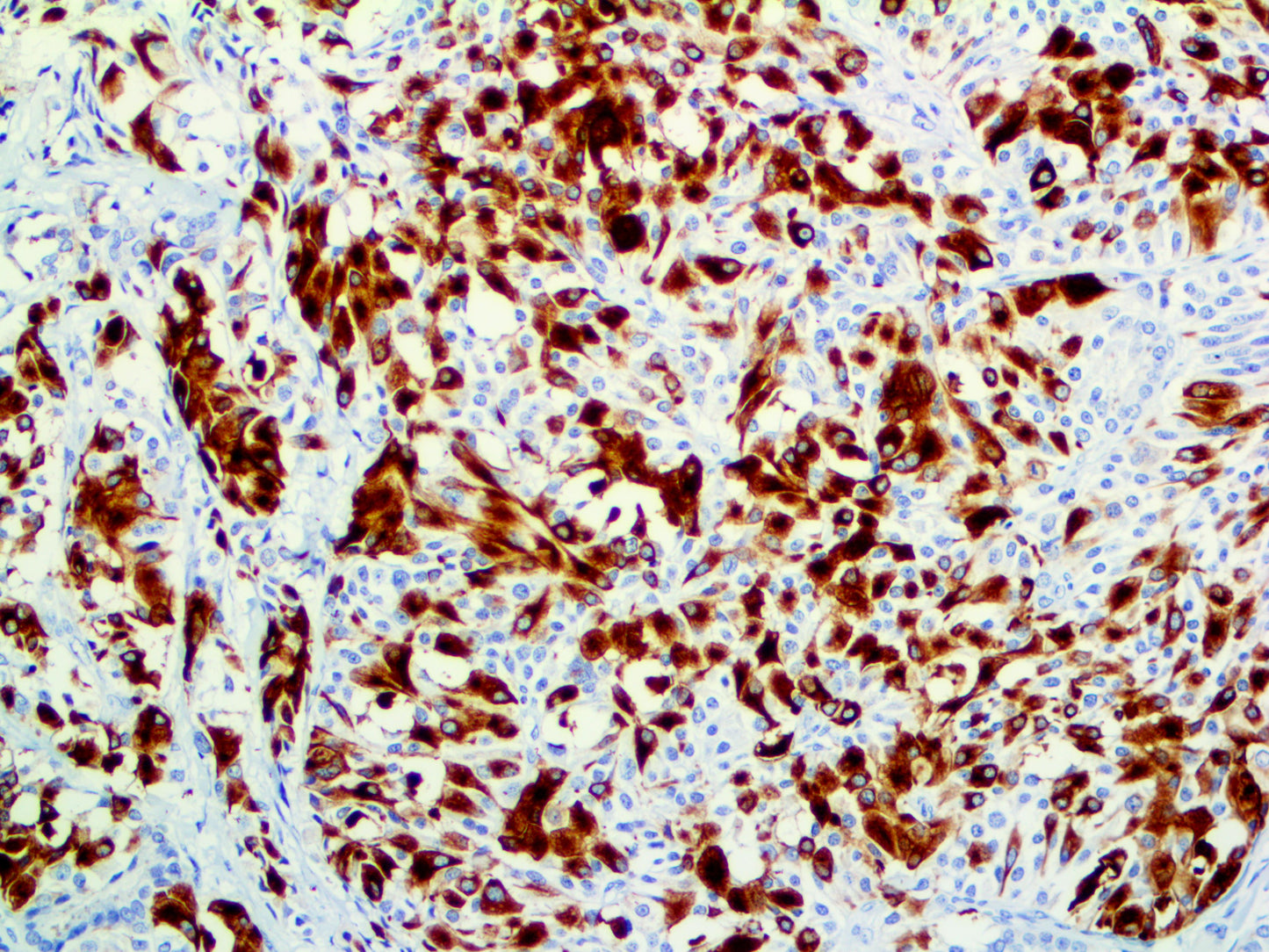 Cytokeratin 19