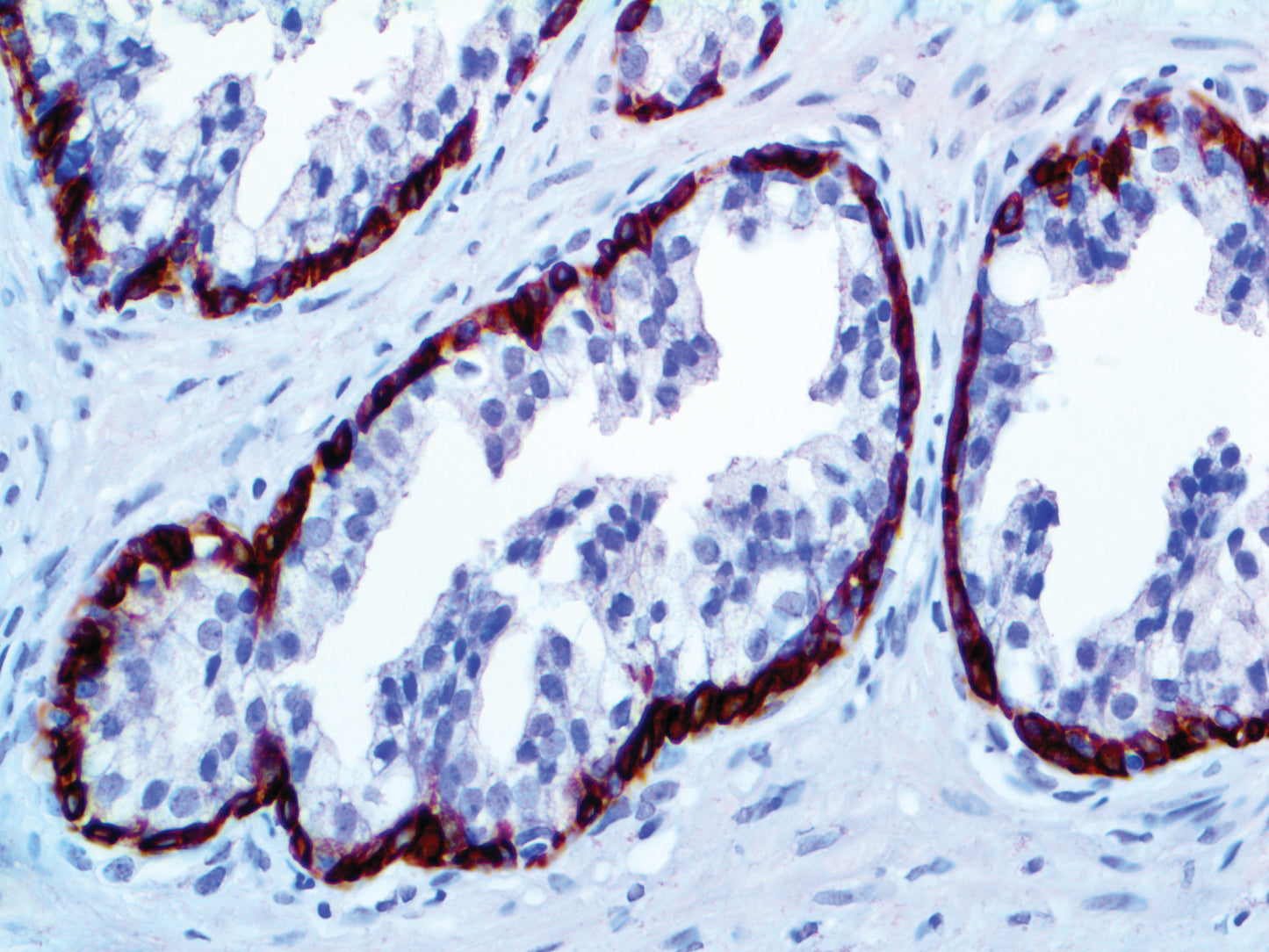 Cytokeratin HMW 34BE12