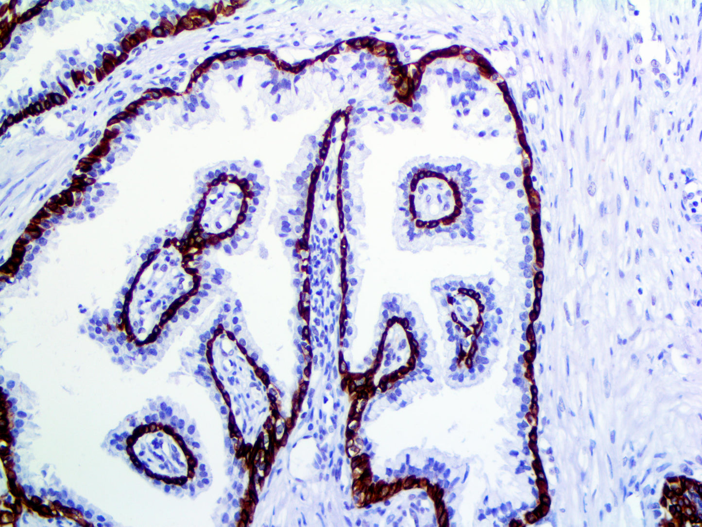Cytokeratin 5 & 6