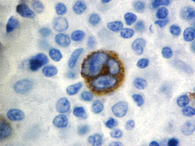 Epstein Barr Virus LMP-1