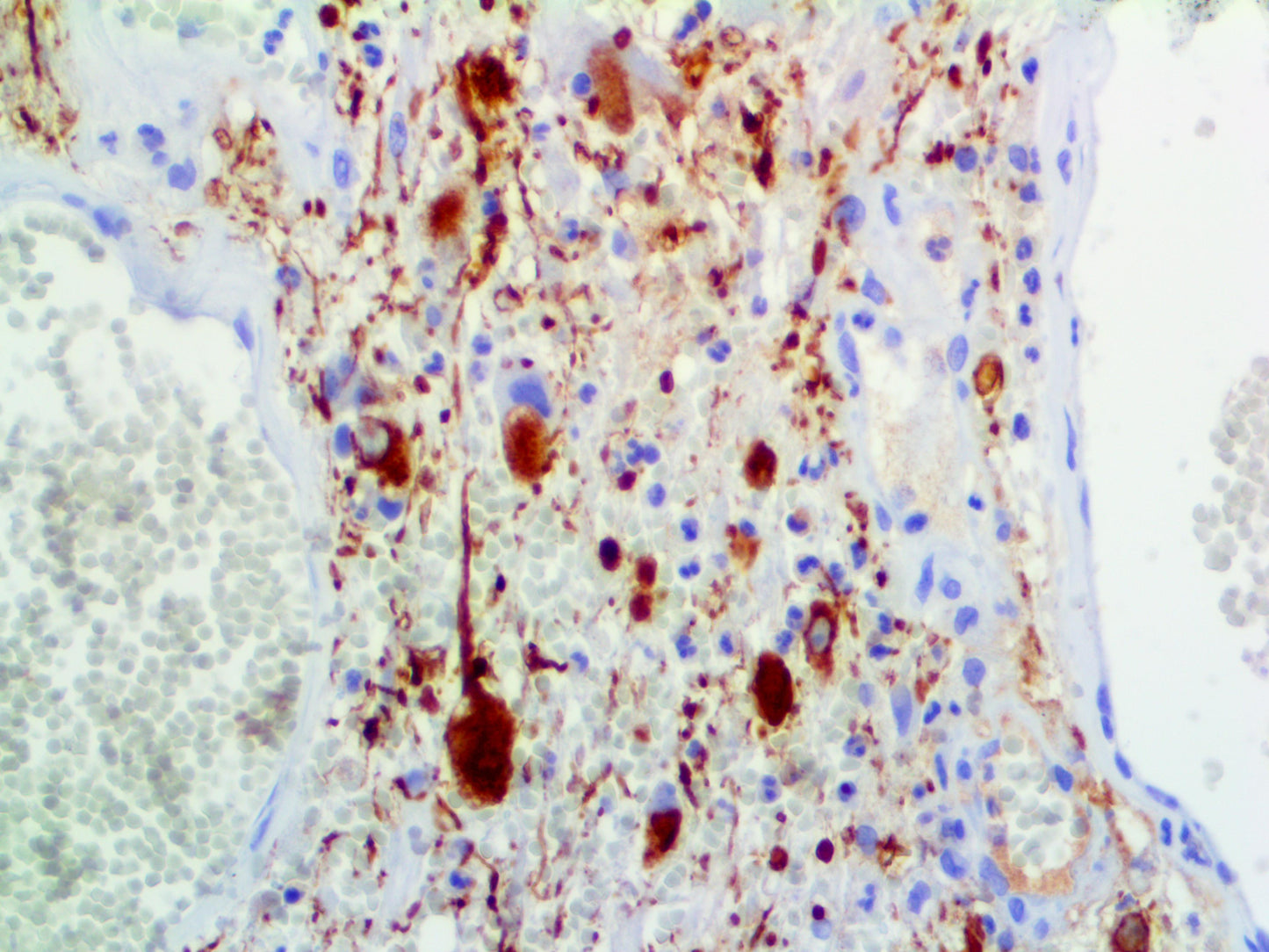 Neurofilament