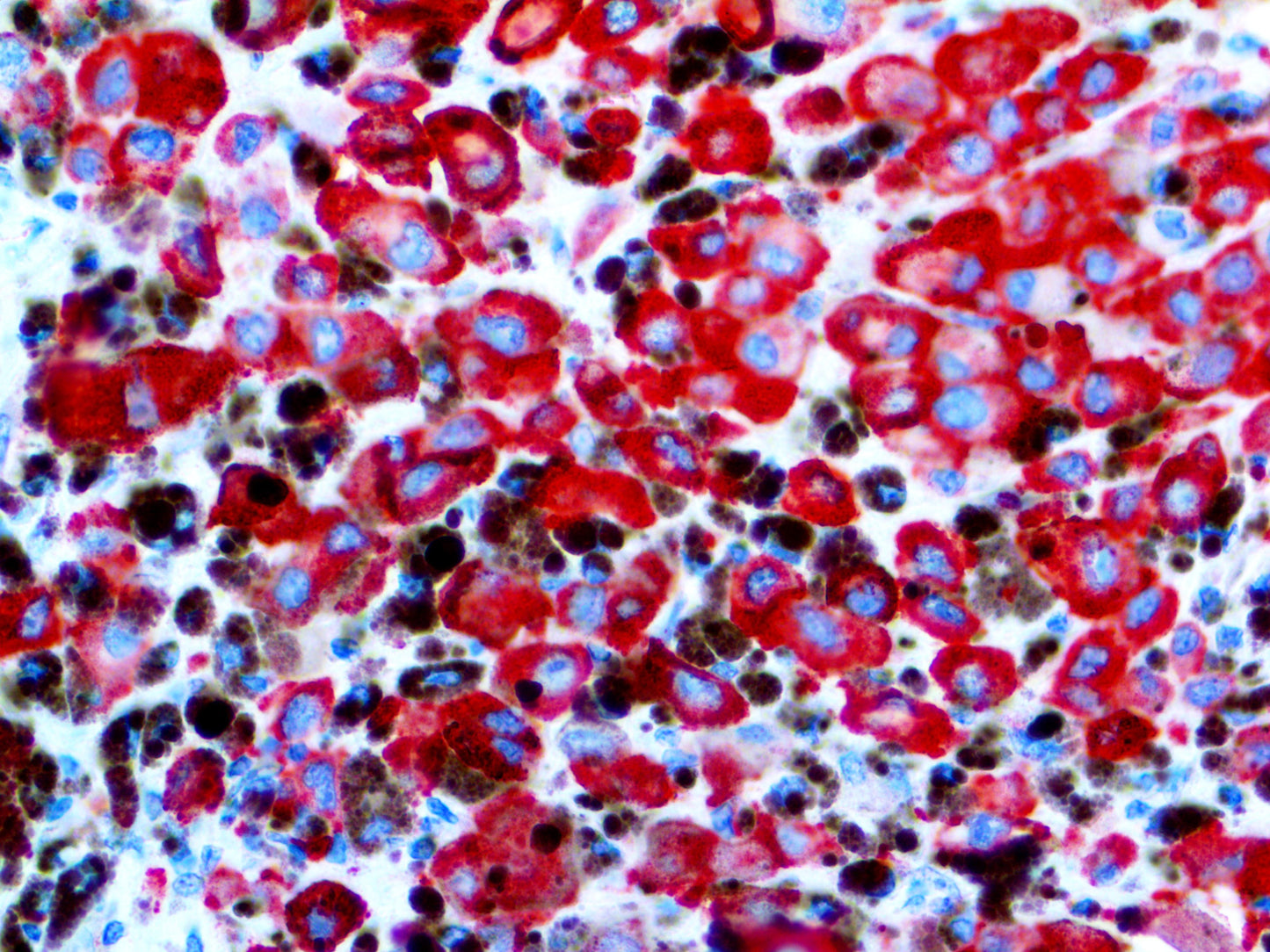 Melanoma PNL2