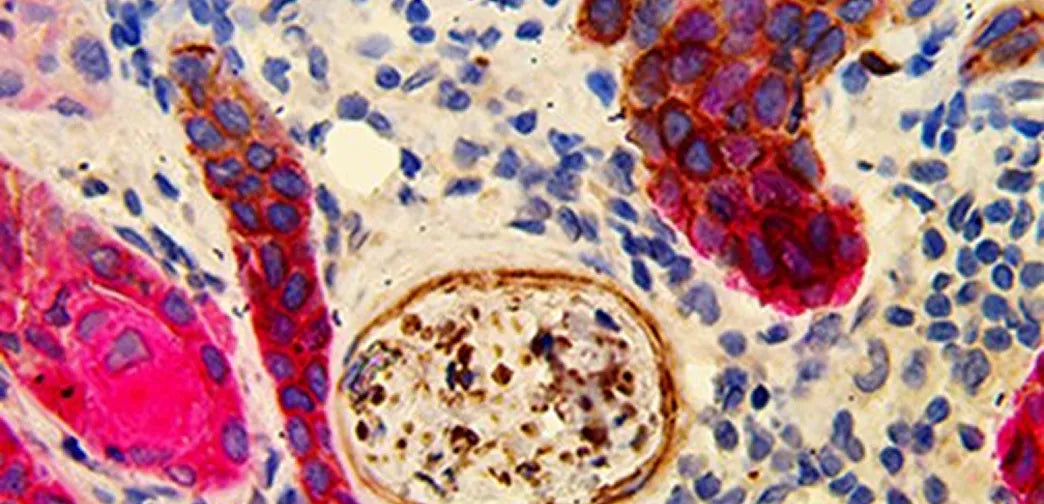NGFR MMab & CK 5/6 RMab