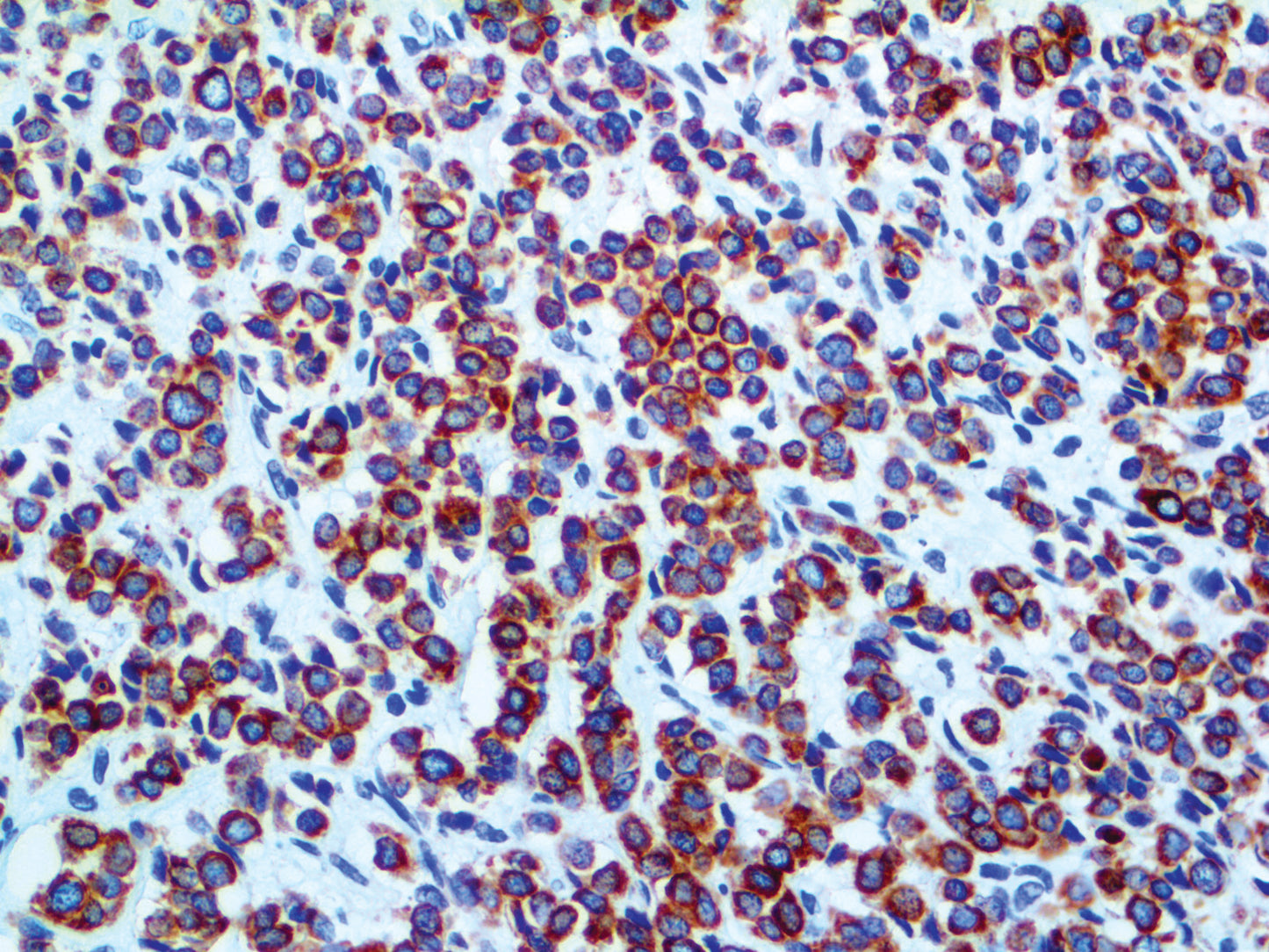 Cytokeratin LMW CAM5.2