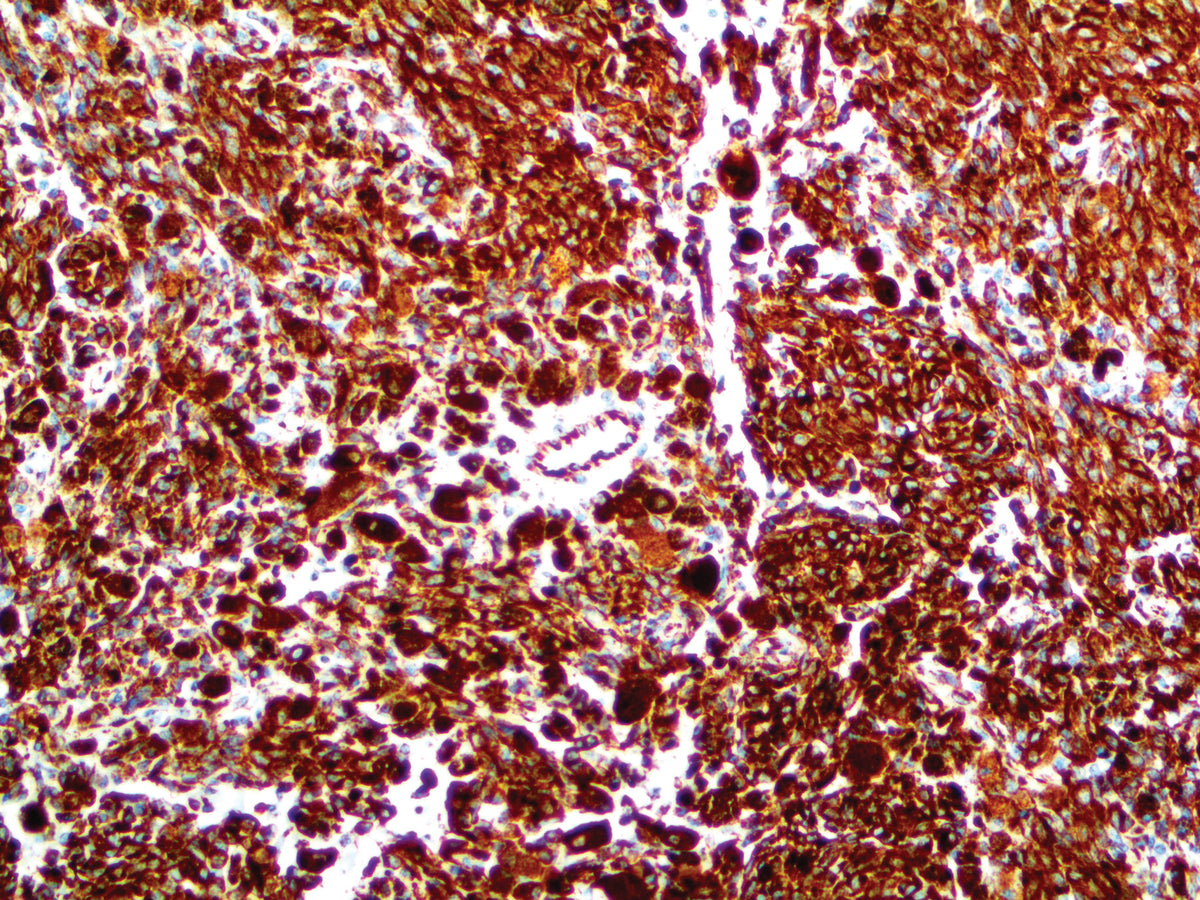 Vimentin