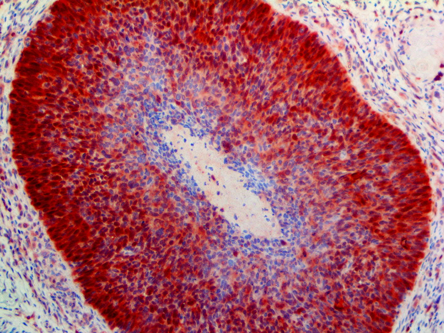 CDK4