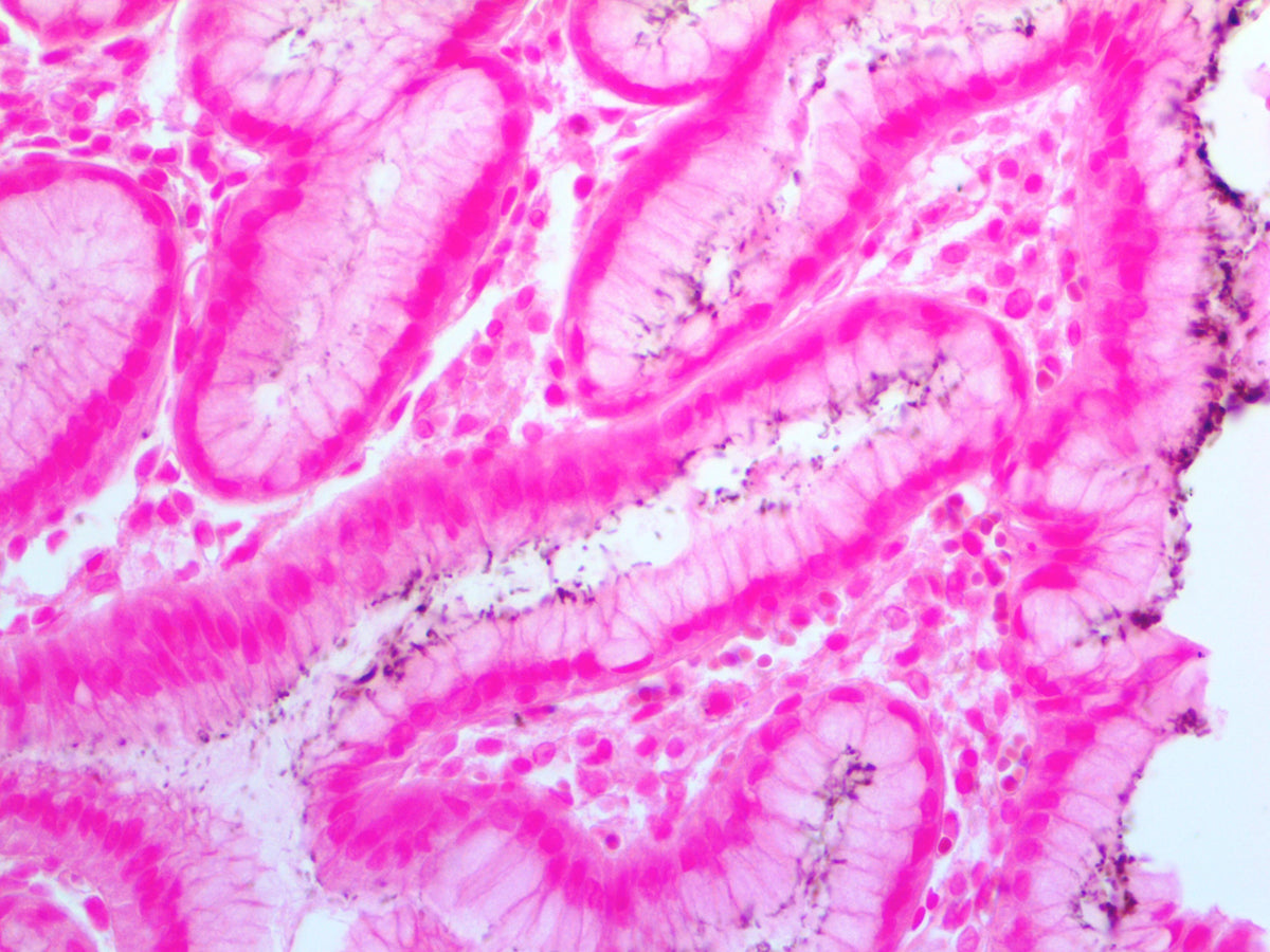 Helicobacter Pylori