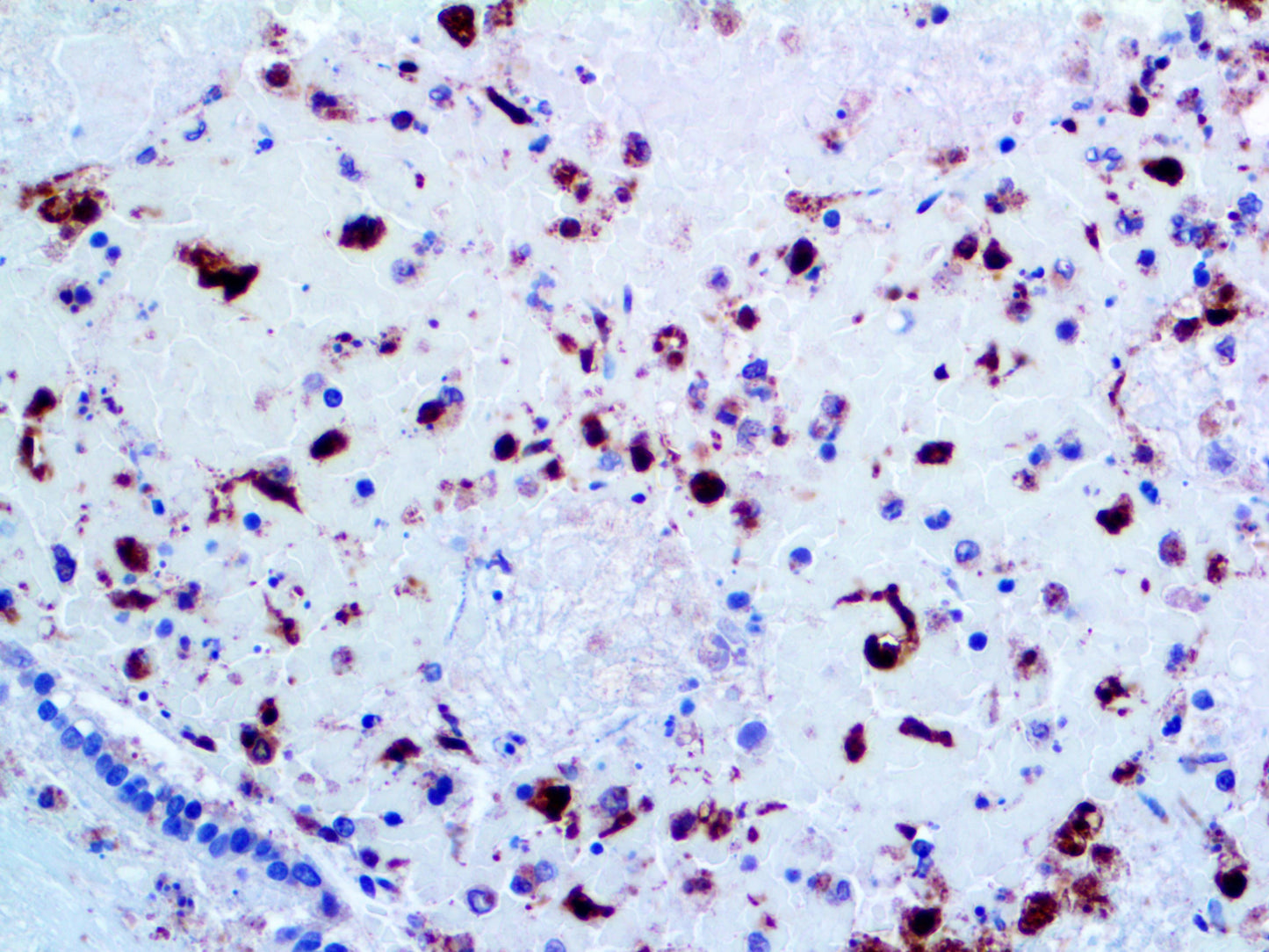 Herpes Simplex Virus I