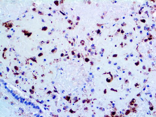 Herpes Simplex Virus I