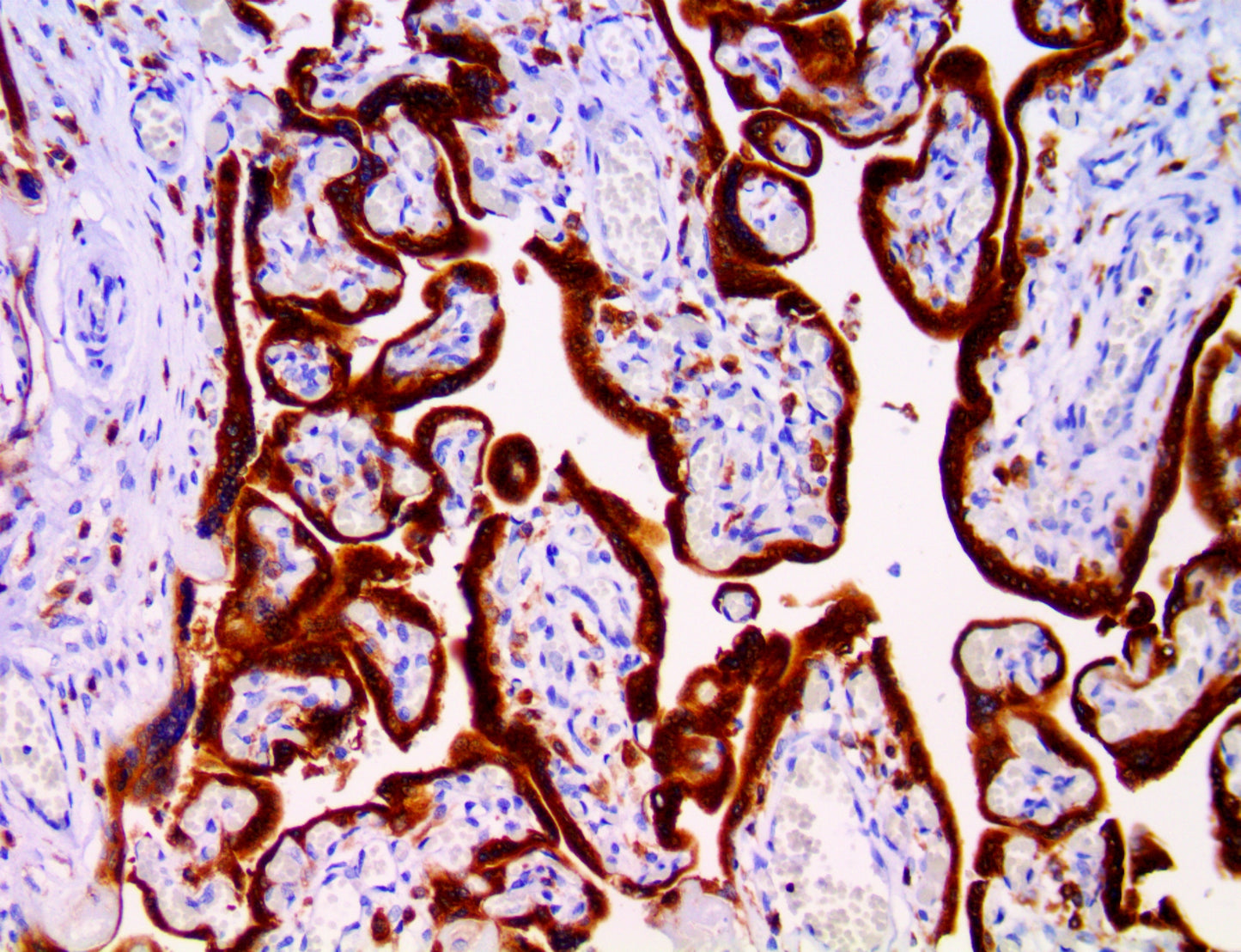 IMP-3\1GF2BP3