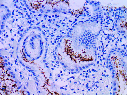 Helicobacter Pylori