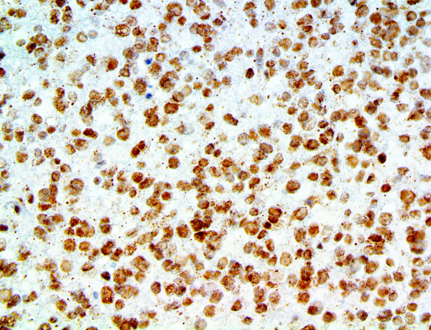 Amyloid Beta