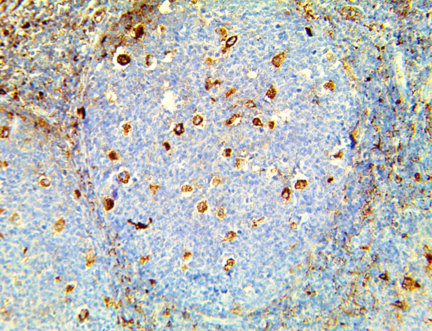 A-1-Antichymotrypsin