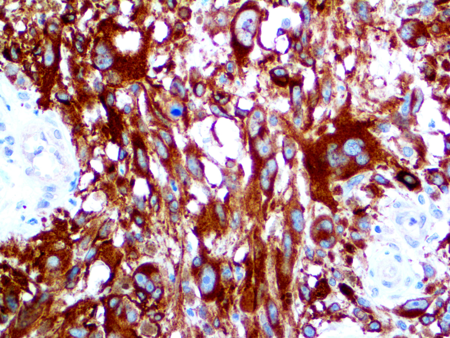 TintoFast Melanoma Cocktail: HMB-45, Mart-1 and Tyrosinase