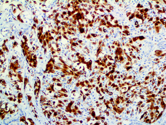 Cytokeratin 19