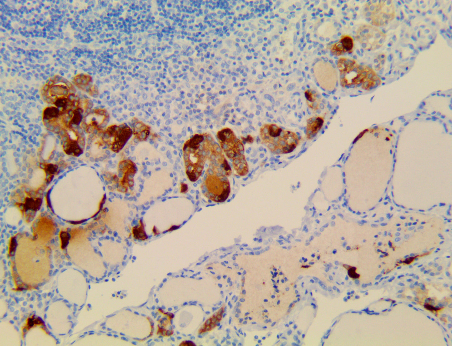 Calcitonin
