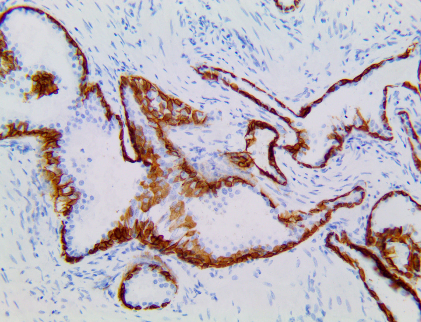 Cytokeratin 5 & 6