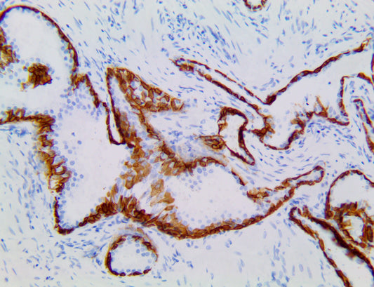 Cytokeratin 5 & 6