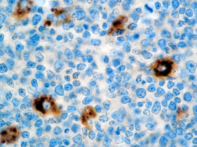 A-1-Antitrypsin