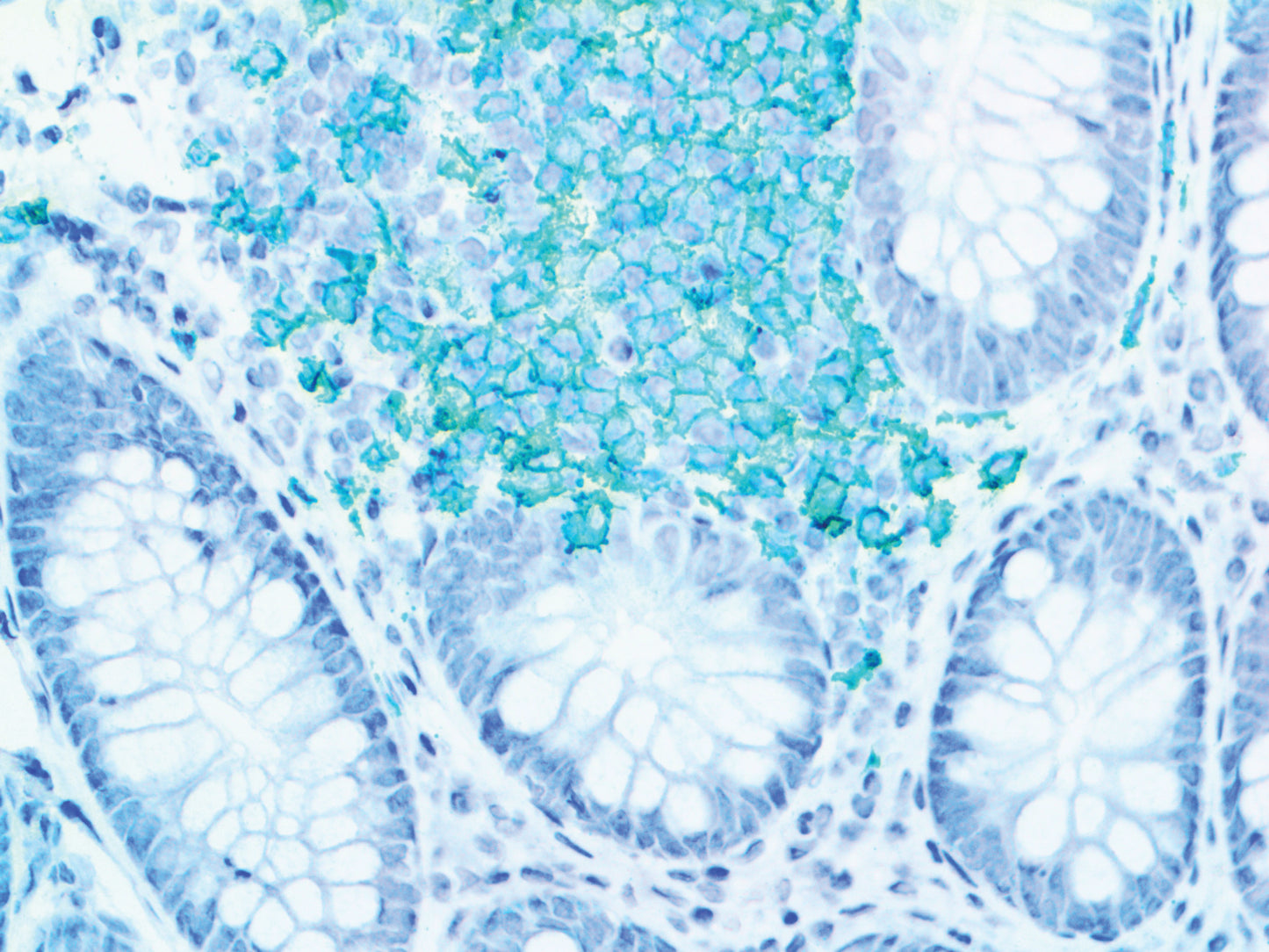 CD3 Epsilon