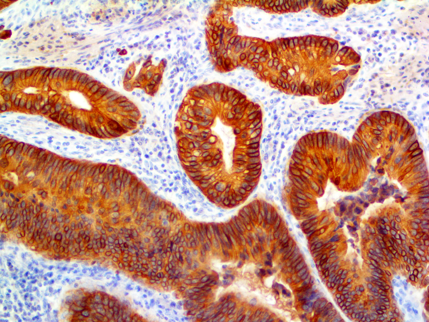 Cytokeratin 20