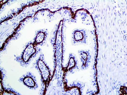 Cytokeratin 5 & 6
