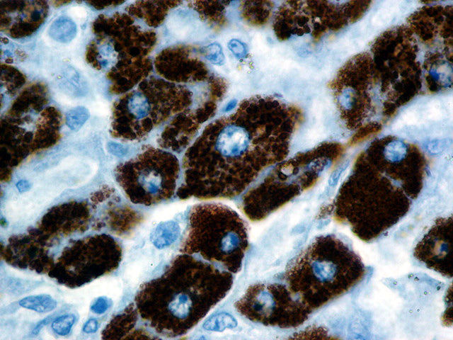 Hepatocyte Specific Antigen\Hep-Par1