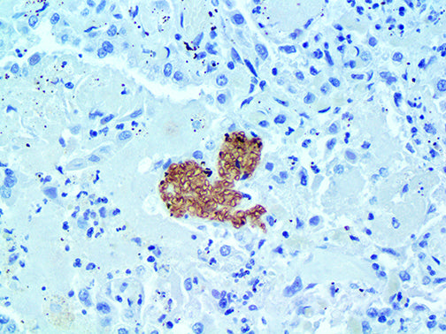 Pneumocystis jirovecii