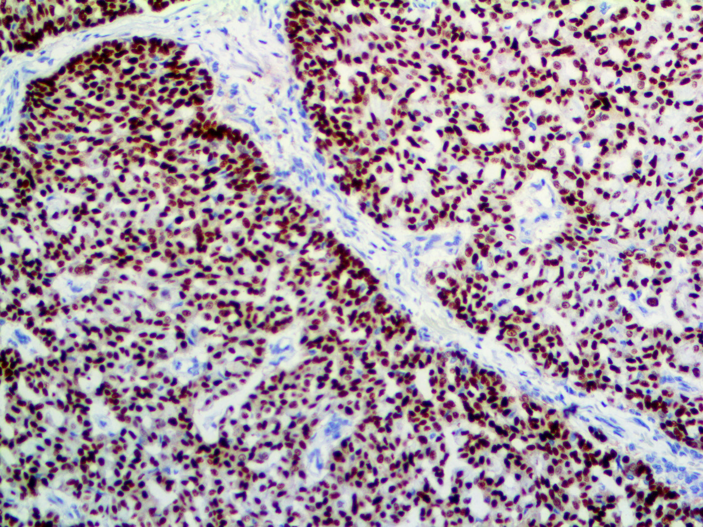 Progesterone Receptor
