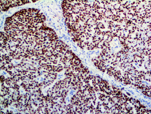Progesterone Receptor