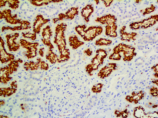 Renal Cell Carcinoma