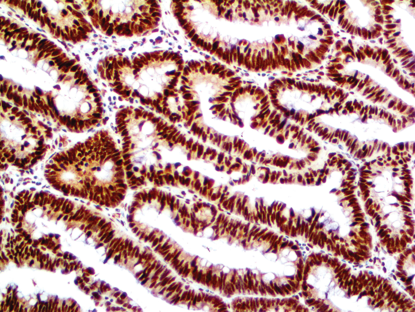 Retinoblastoma\Rb