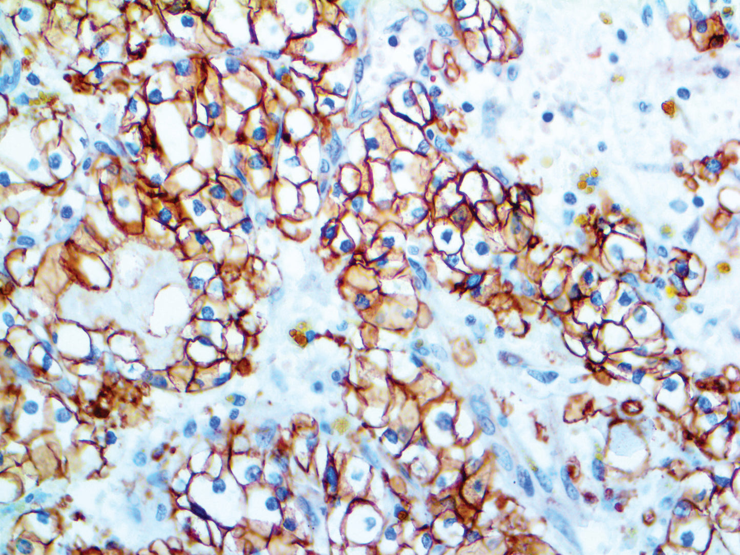 Carbonic Anhydrase 9