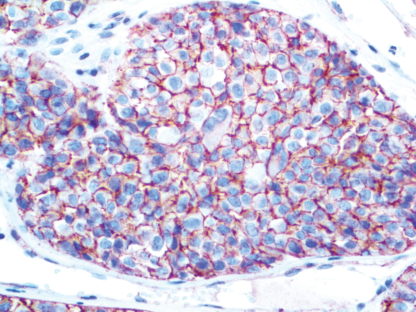 Melanoma KBA.62