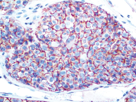 Melanoma KBA.62