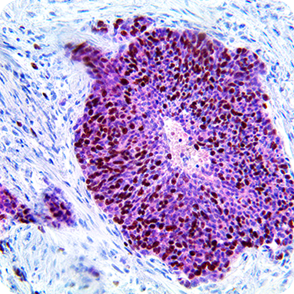 HPV MultiDetector (p16, and Ki-67)