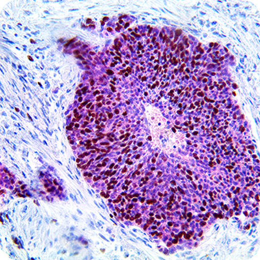 HPV MultiDetector (p16, and Ki-67)