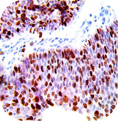 HPV MultiDetector (p16, and Ki-67)