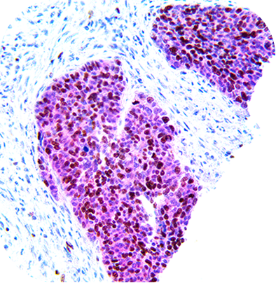 HPV MultiDetector (p16, and Ki-67)