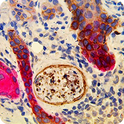 PNI Carcinoma MultiDetector HRP/AP Kit