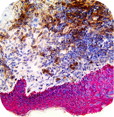 PNI Carcinoma MultiDetector HRP/AP Kit