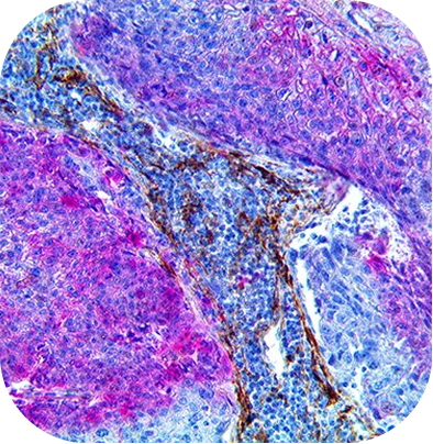 PNI Carcinoma MultiDetector HRP/AP Kit