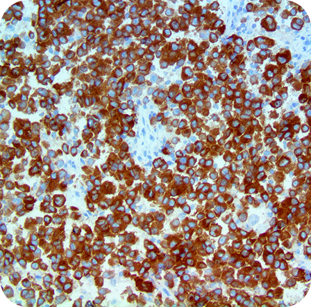 IHC of MART-1