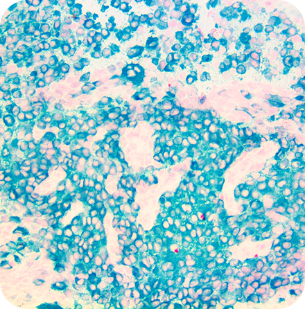 IHC of MART-1