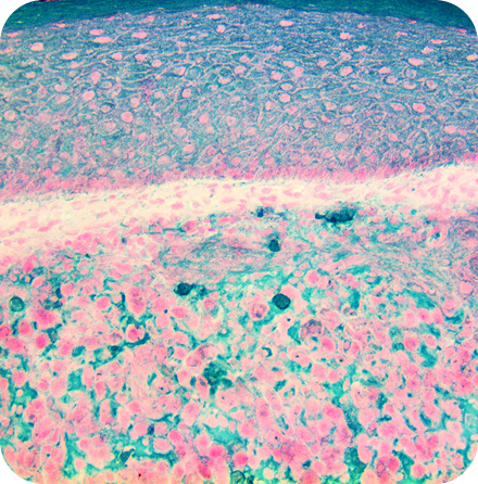 IHC of CK AE1/AE3